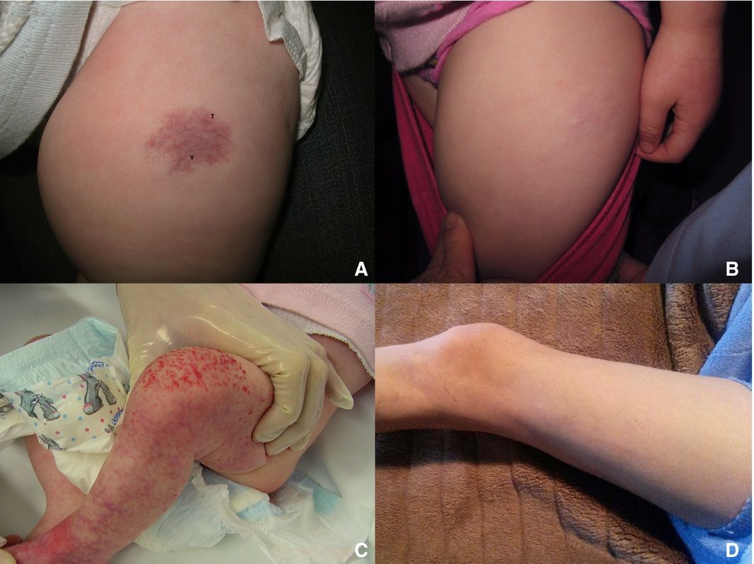 写真は、患者4における（A）発症時および（B）消退時の乳児血管腫（上段左右の写真）、および患者5における（C）発症時および（D）消退時の乳児血管腫（下段左右の写真）を示す。