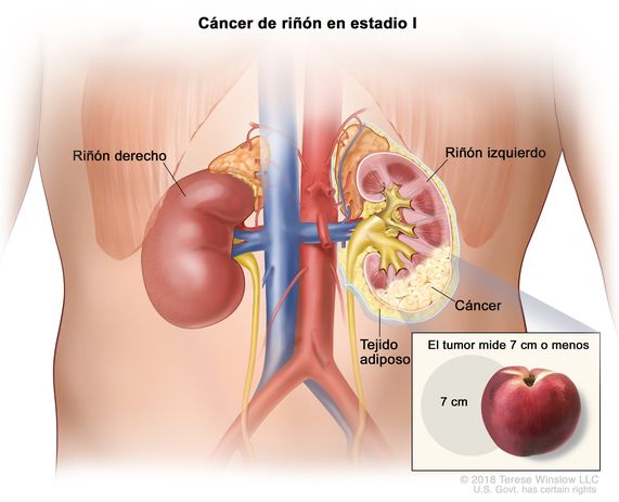 Cáncer de riñón en estadio I; en la ilustración se muestra cáncer en el riñón izquierdo y que el tumor mide  7 cm o menos. En el recuadro se muestra que 7 cm es casi el tamaño de un durazno. También se observa el tejido adiposo y el riñón derecho.