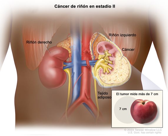 Cáncer de riñón en estadio II. En el dibujo se observa un cáncer en el riñón izquierdo que mide más de 7 cm. En el recuadro se muestra que un tumor de 7 cm es casi del tamaño de un durazno. También se observa el tejido adiposo y el riñón derecho.