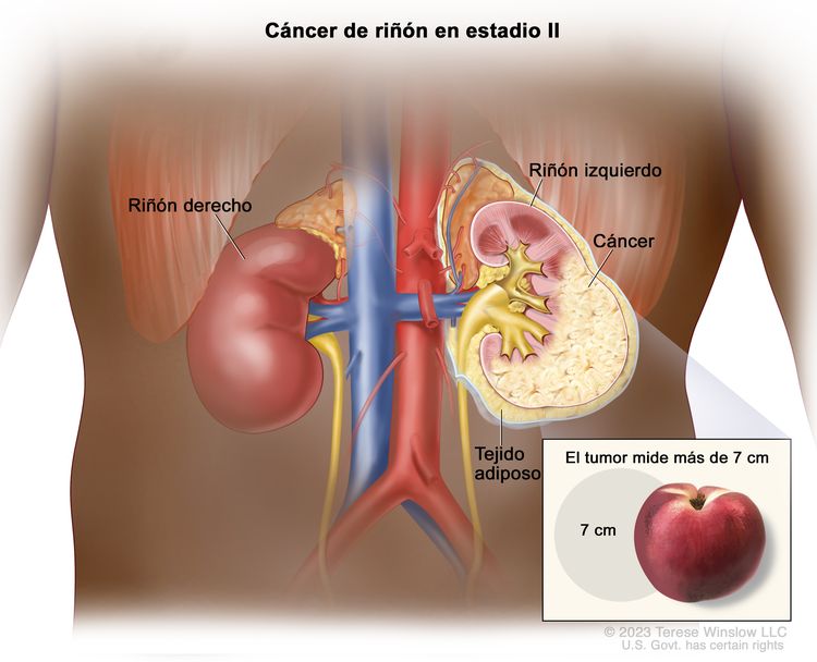 Cáncer de riñón en estadio II. En el dibujo se observa un cáncer en el riñón izquierdo que mide más de 7 cm. En el recuadro se muestra que un tumor de 7 cm es casi del tamaño de un durazno. También se observa el tejido adiposo y el riñón derecho.