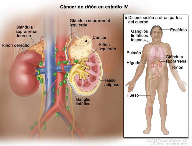 Cáncer de riñón en estadio IV; en la ilustración se muestra cáncer que se diseminó más allá de la capa de tejido adiposo que rodea el riñón izquierdo hasta: a) la glándula suprarrenal ubicada encima del riñón izquierdo; también se muestran los ganglios linfáticos, la glándula suprarrenal derecha y el riñón derecho; o b) según se observa en el recuadro, otras partes del cuerpo a las que el cáncer de riñón tal vez se diseminó, como el encéfalo, el pulmón, el hígado, la glándula suprarrenal, el hueso o los ganglios linfáticos lejanos.
