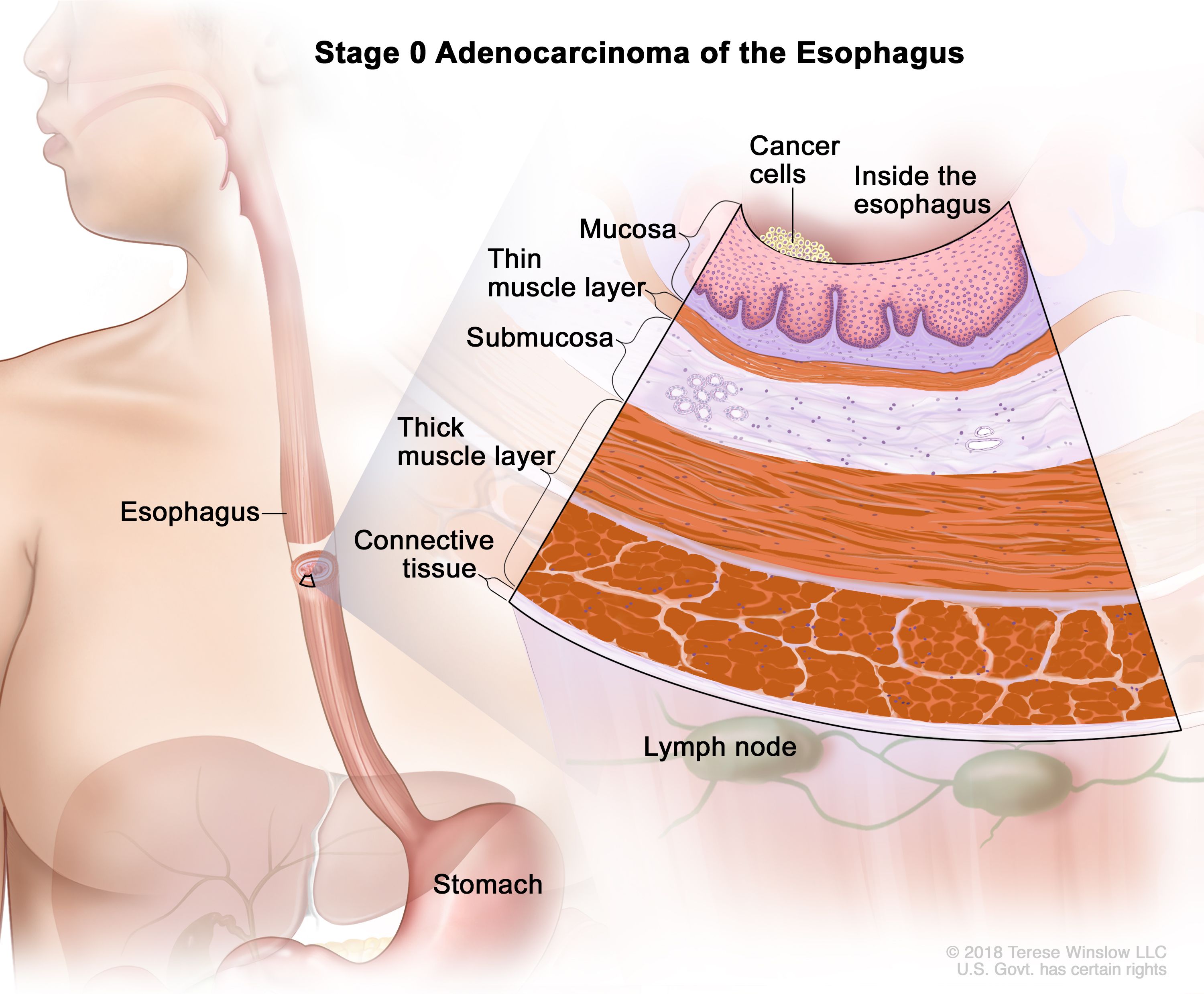 Étapes de l'adénocarcinome de l'œsophage