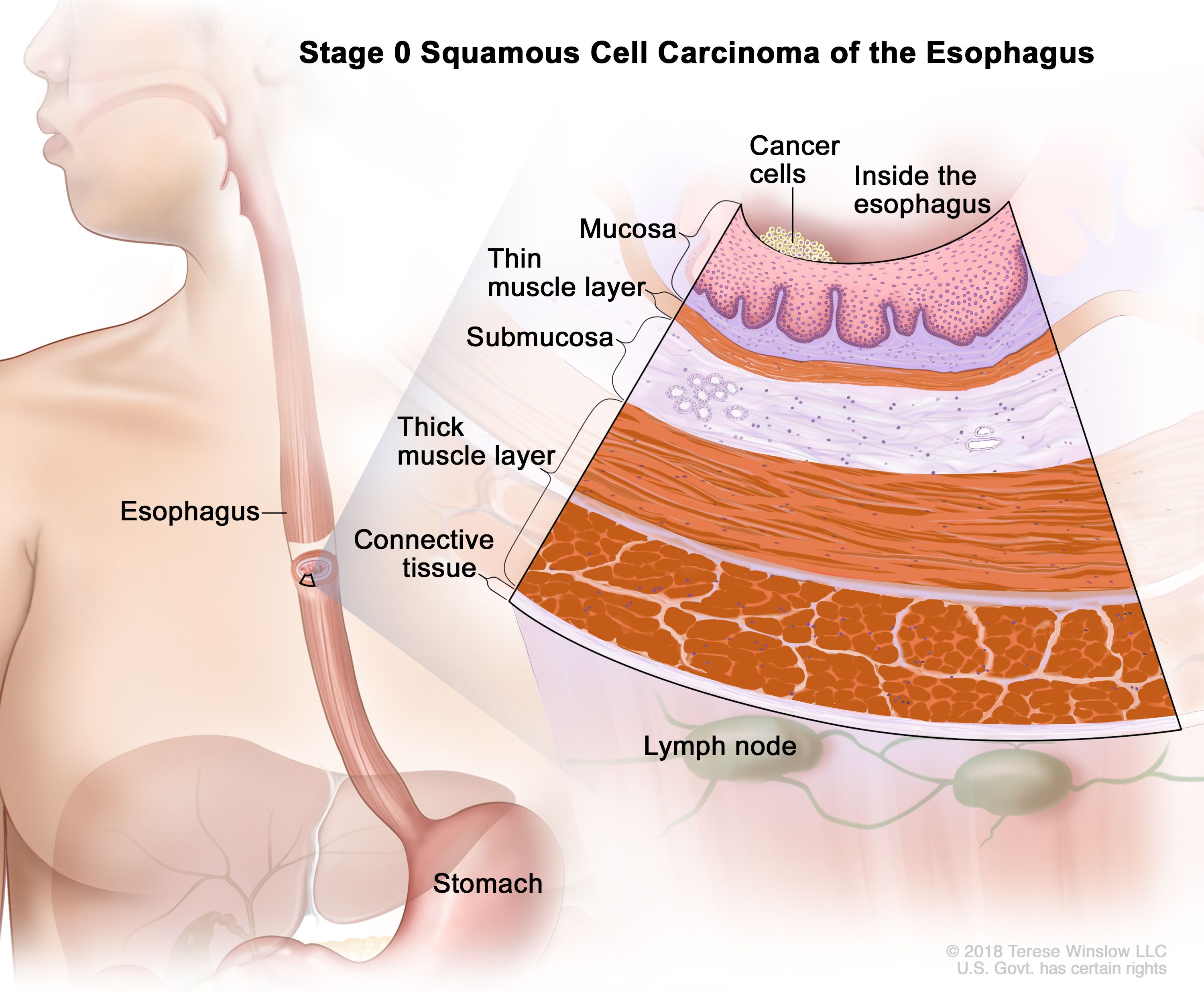 Stades du cancer de l'œsophage