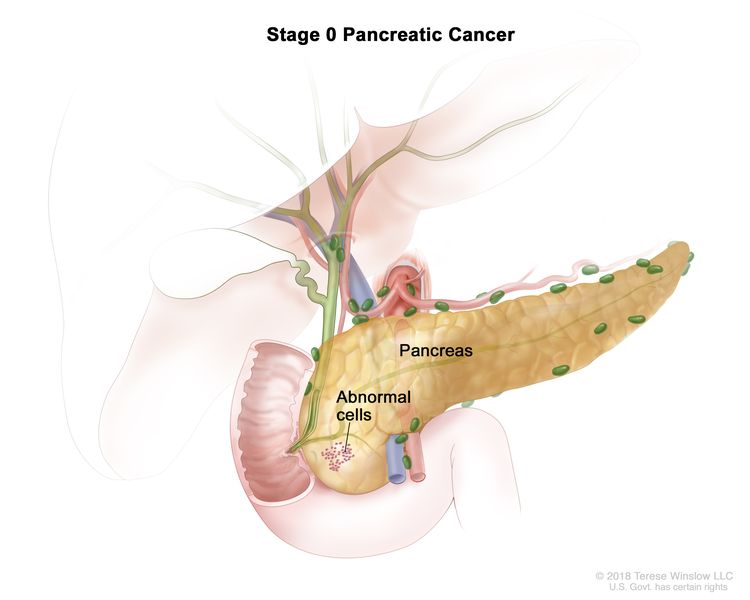 Stage 0 pancreatic cancer; drawing shows abnormal cells in the pancreas.