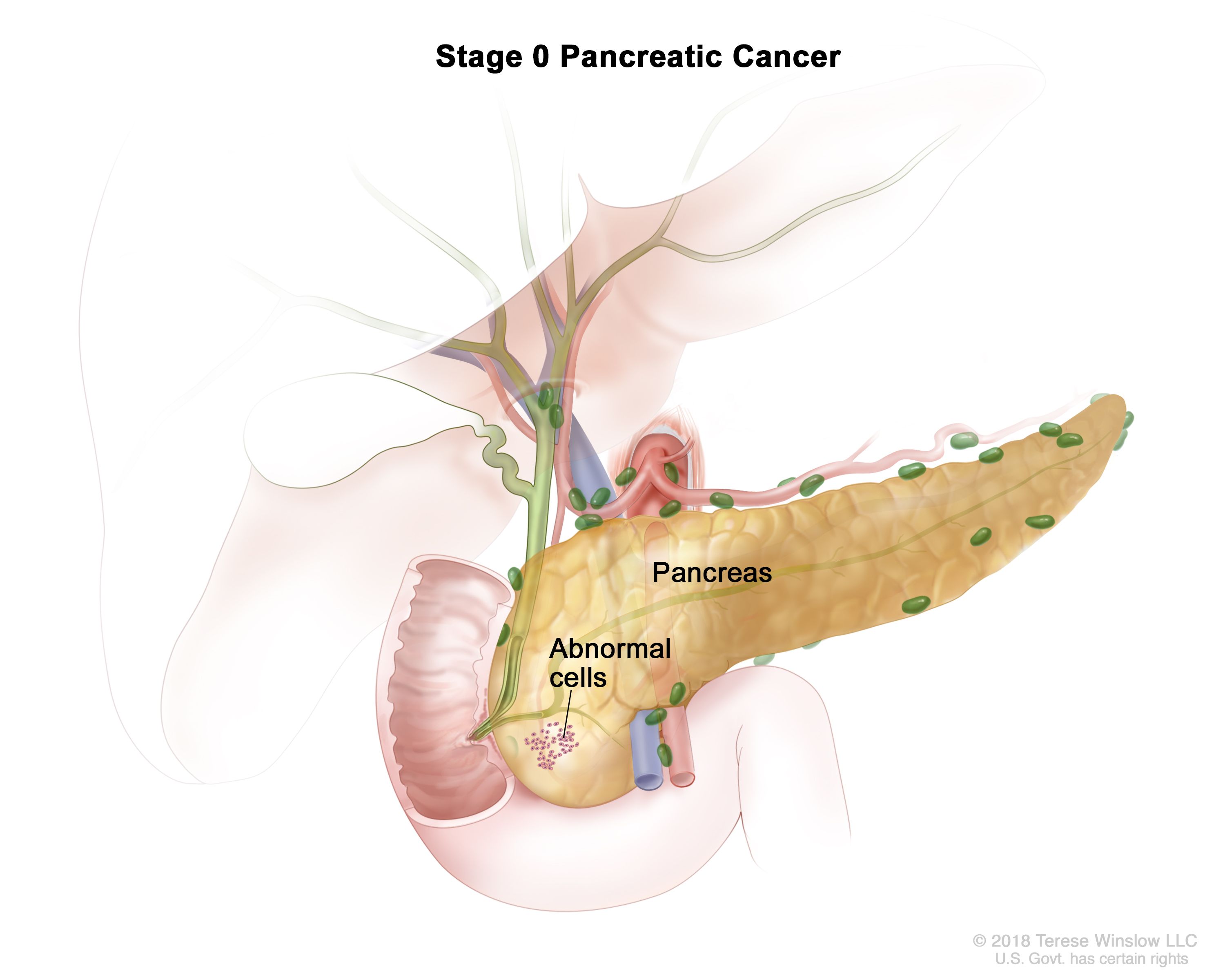 Pancreatic Cancer Treatment Adult Pdq Patient Version National Cancer Institute