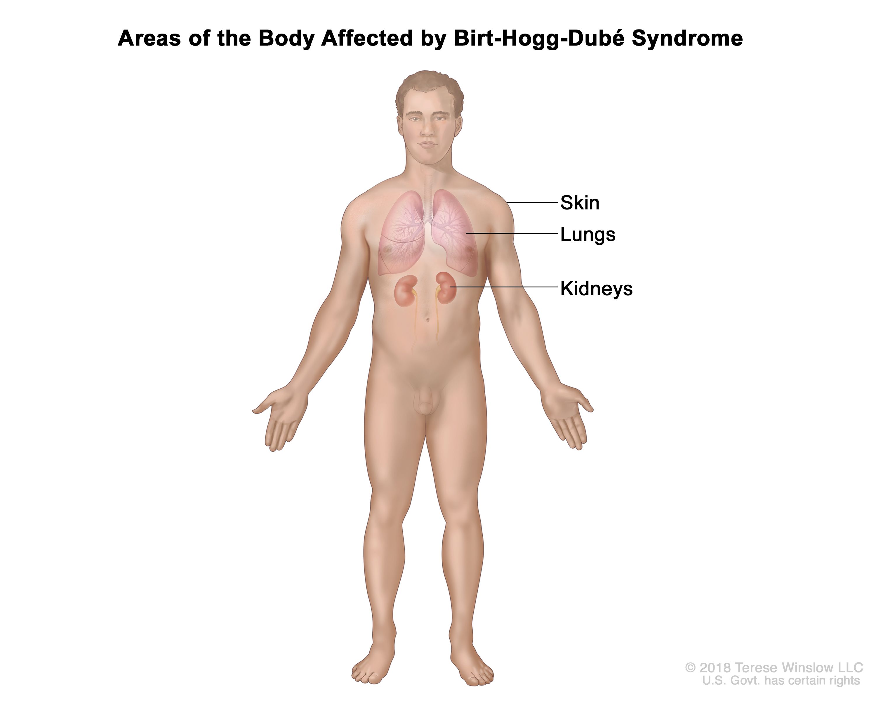 Birt hogg dube syndrome
