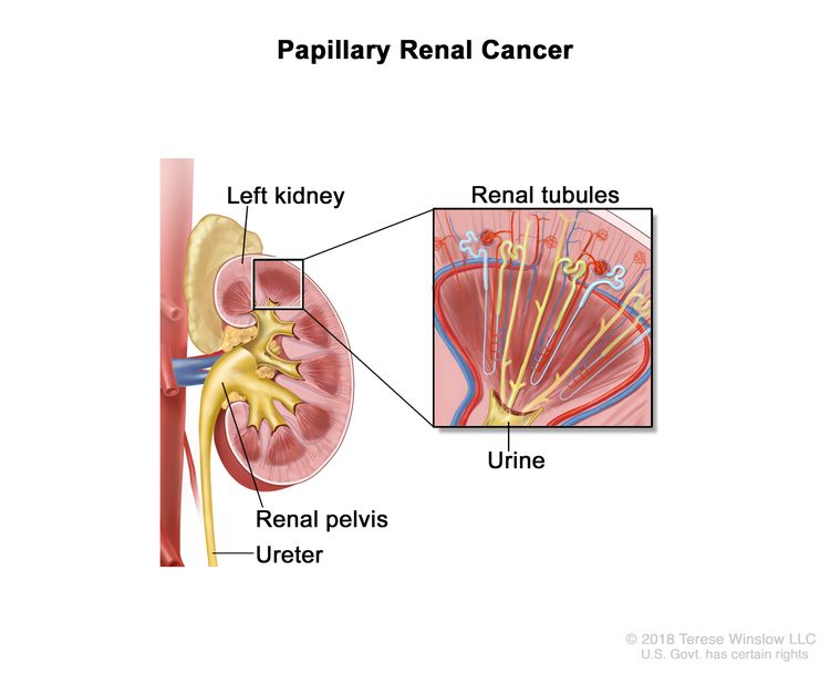 Papillary renal cancer; drawing showing the left kidney, renal pelvis, and ureter. Also shown is a pullout of the renal tubules, which is where urine is made.