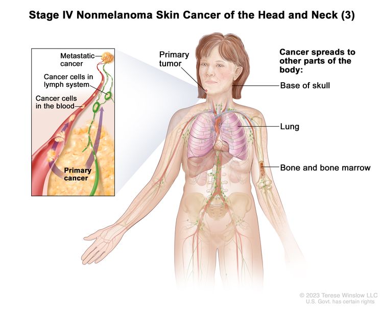 Stage IV nonmelanoma skin cancer of the head and neck (3); drawing shows a primary skin tumor on the face and other parts of the body where nonmelanoma skin cancer may spread, including the base of the skull, the lung, the bone, and the bone marrow. An inset shows cancer cells spreading through the blood and lymph system to another part of the body where metastatic cancer has formed.