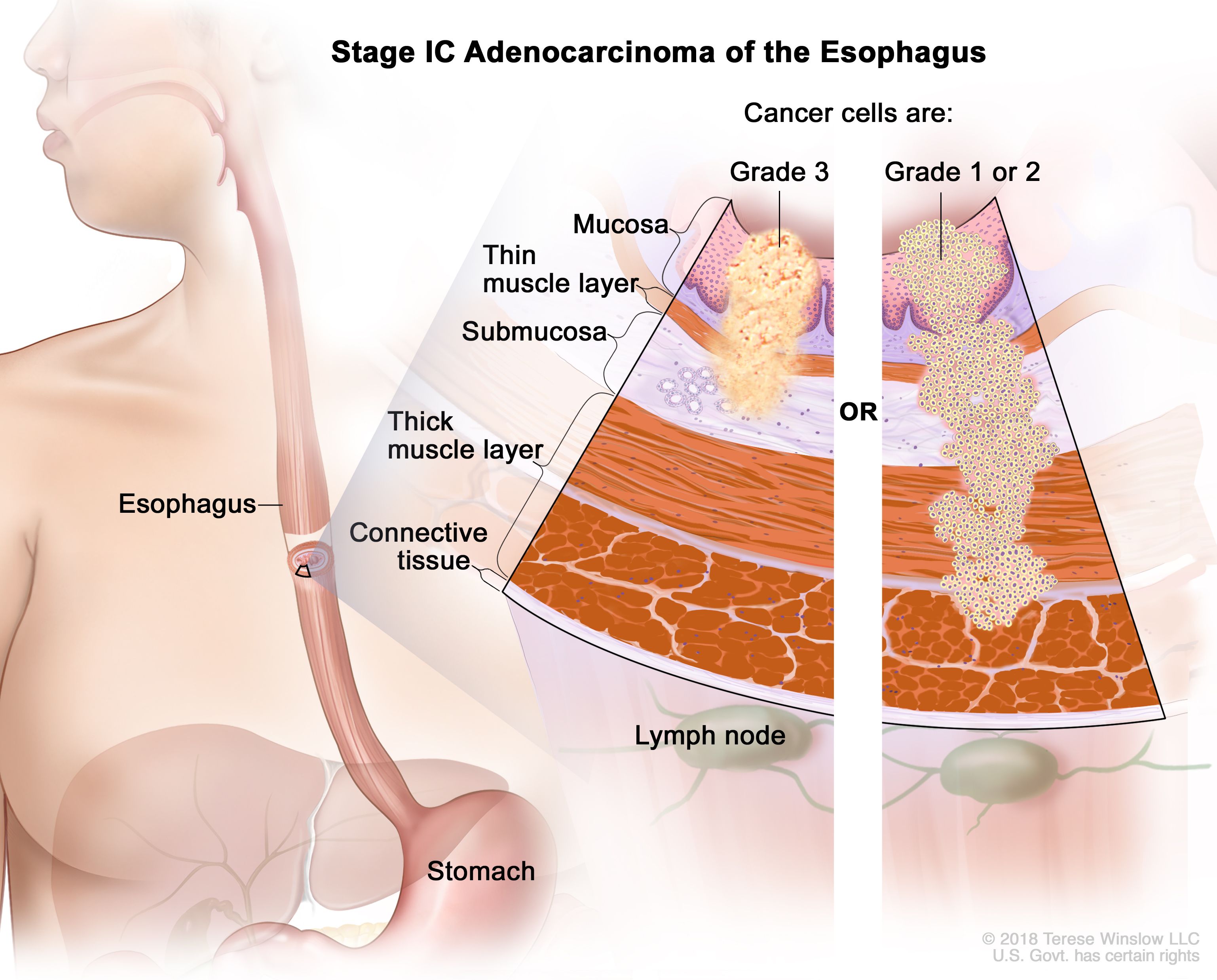 Adénocarcinome de stade IC de l'œsophage