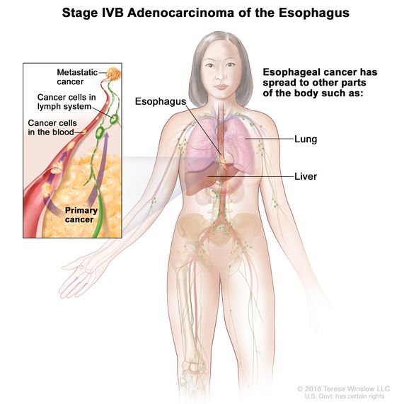 Definition Of Stage Iv Esophageal Adenocarcinoma Nci Dictionary Of Cancer Terms National Cancer Institute