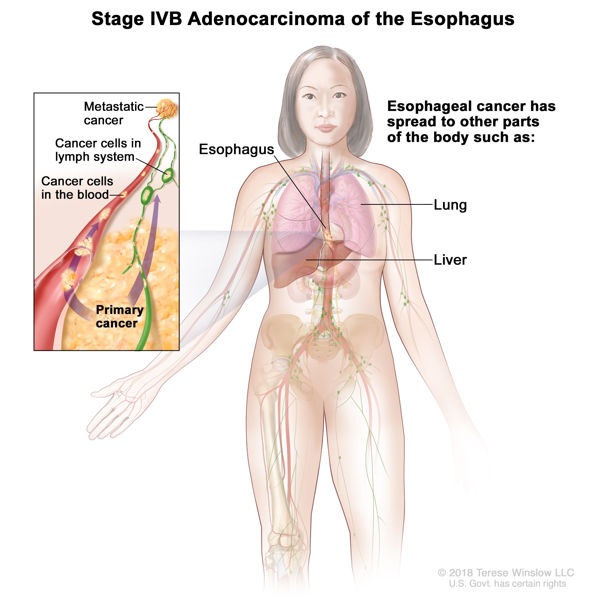 Adénocarcinome de stade IVB de l'œsophage