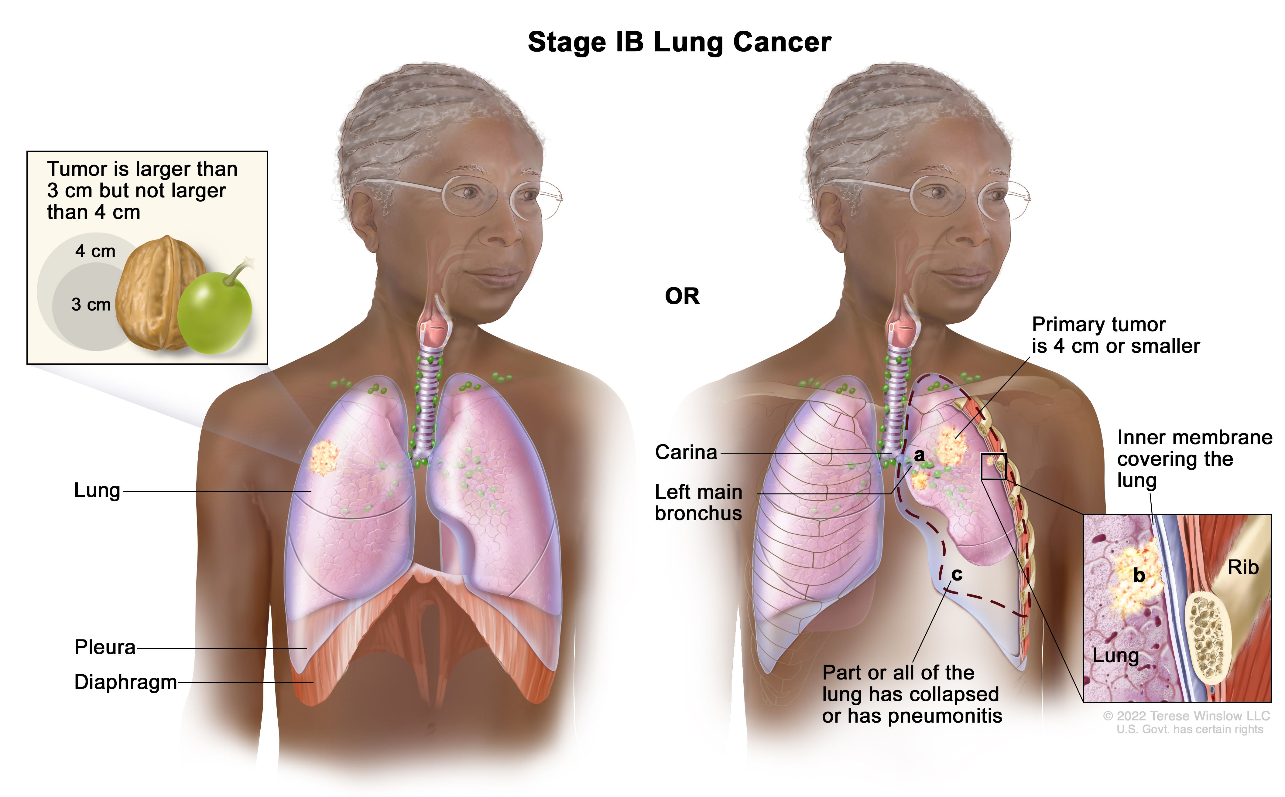 metastatic cancer lung treatment