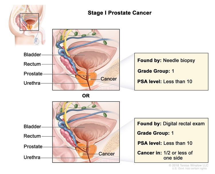 prostate cancer treatment early