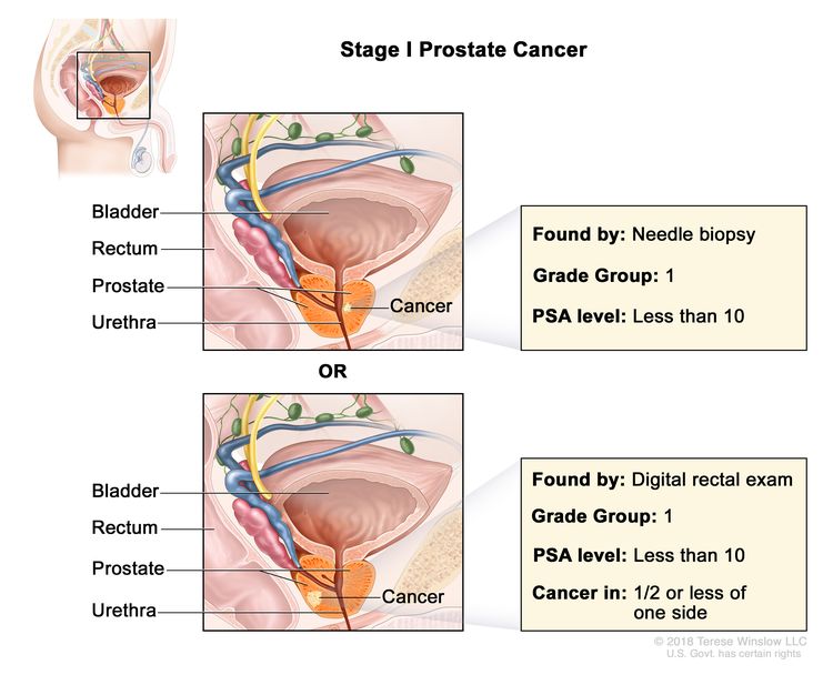 early prostate cancer treatment