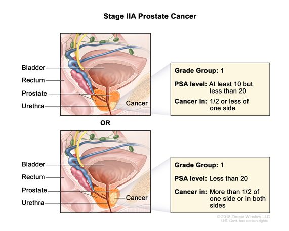 prostate cancer symptoms stage 1