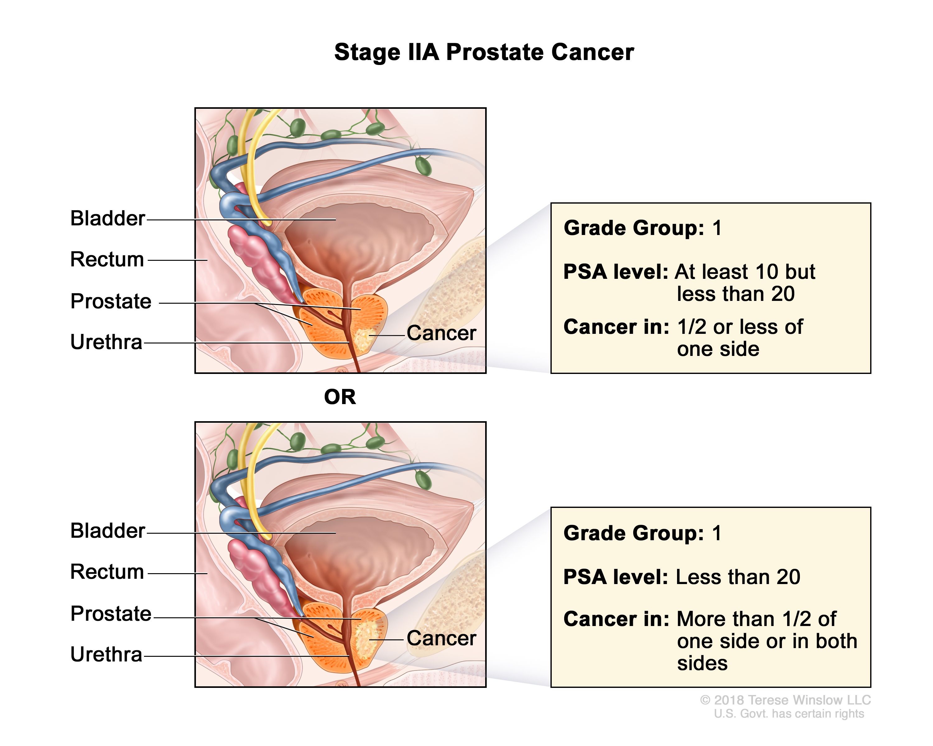 prostate cancer prognosis stage 2