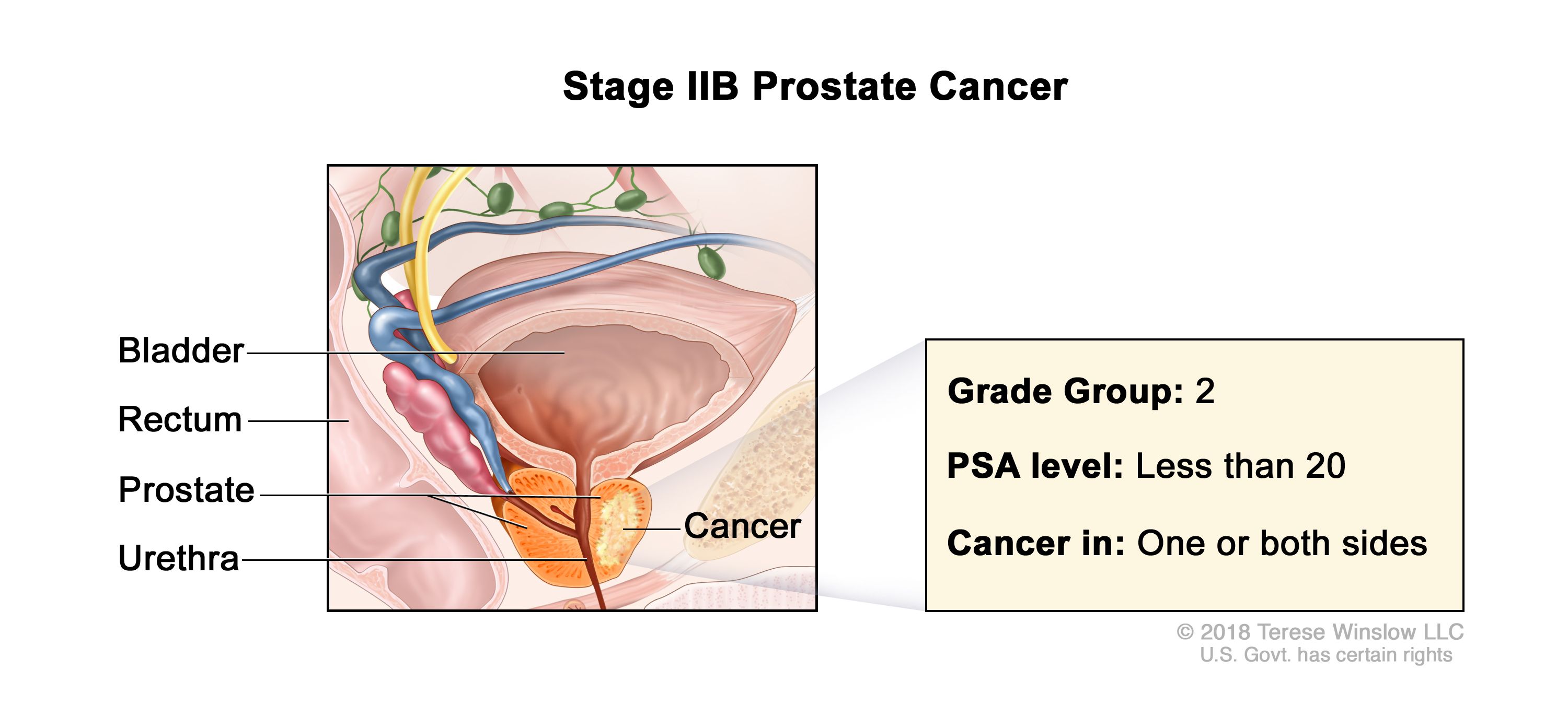 prostate cancer stage 2b treatment