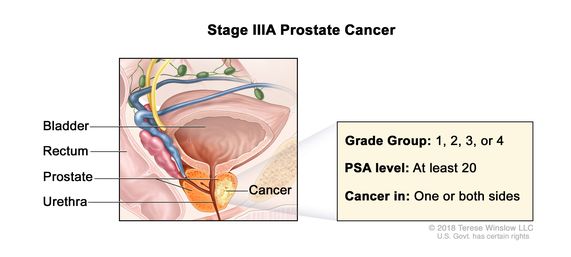 stage 3 prostate cancer signs