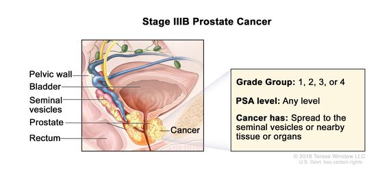 stage 3 prostate cancer symptoms)