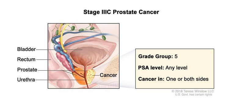 Stage IIIC prostate cancer; drawing shows cancer in one side of the prostate. The PSA can be any level and the Grade Group is 5. Also shown are the bladder, rectum, and urethra.