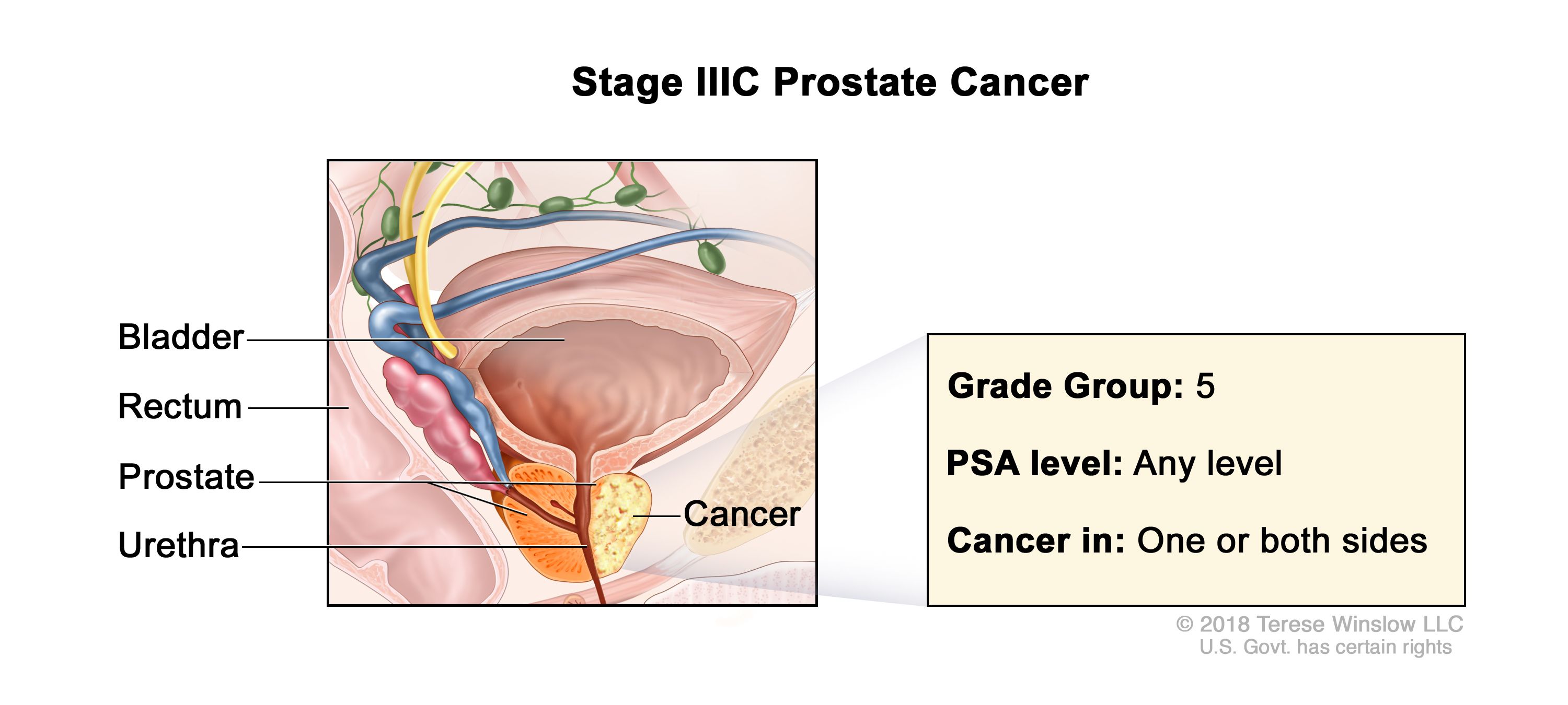 prostate cancer national cancer institute Hogyan kell inni ha súlyosbítja a prosztatitiset