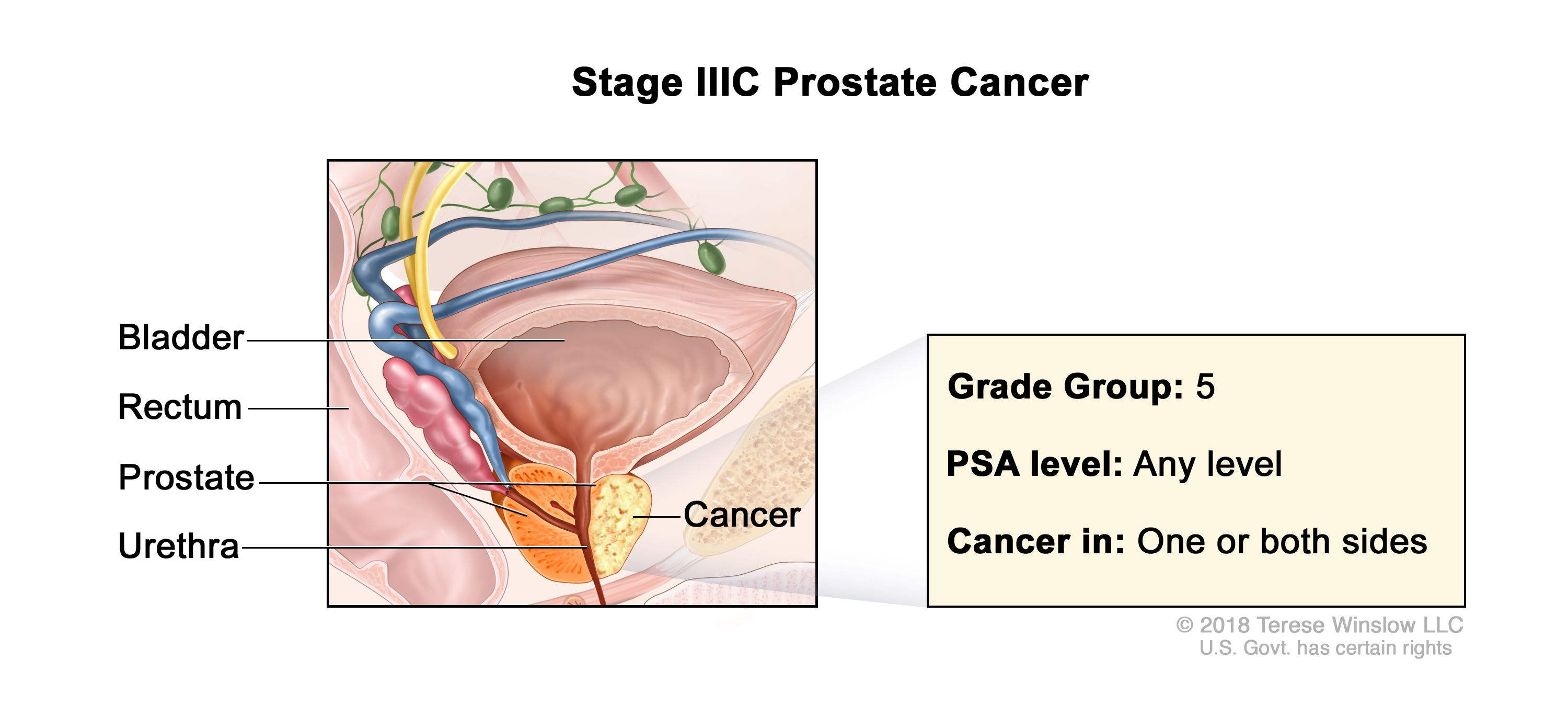 Table], Table 6. Anatomic Stage/Prognostic Groupsa,b - PDQ Cancer