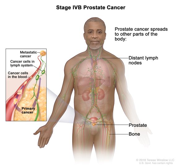 prostate cancer 4th stage prognosis)
