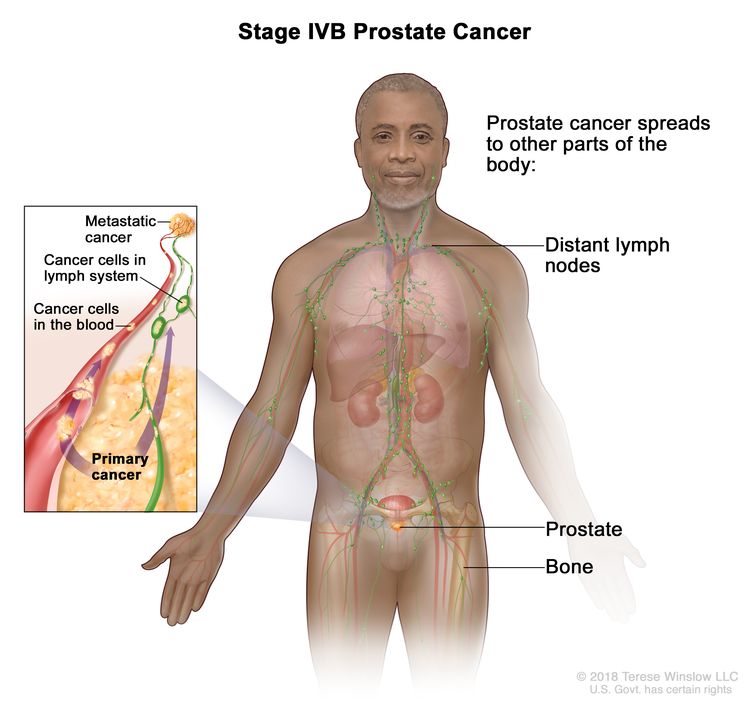 Stage IVB prostate cancer; drawing shows other parts of the body where prostate cancer may spread, including the distant lymph nodes and bones. An inset shows cancer cells spreading from the prostate, through the blood and lymph system, to another part of the body where metastatic cancer has formed.