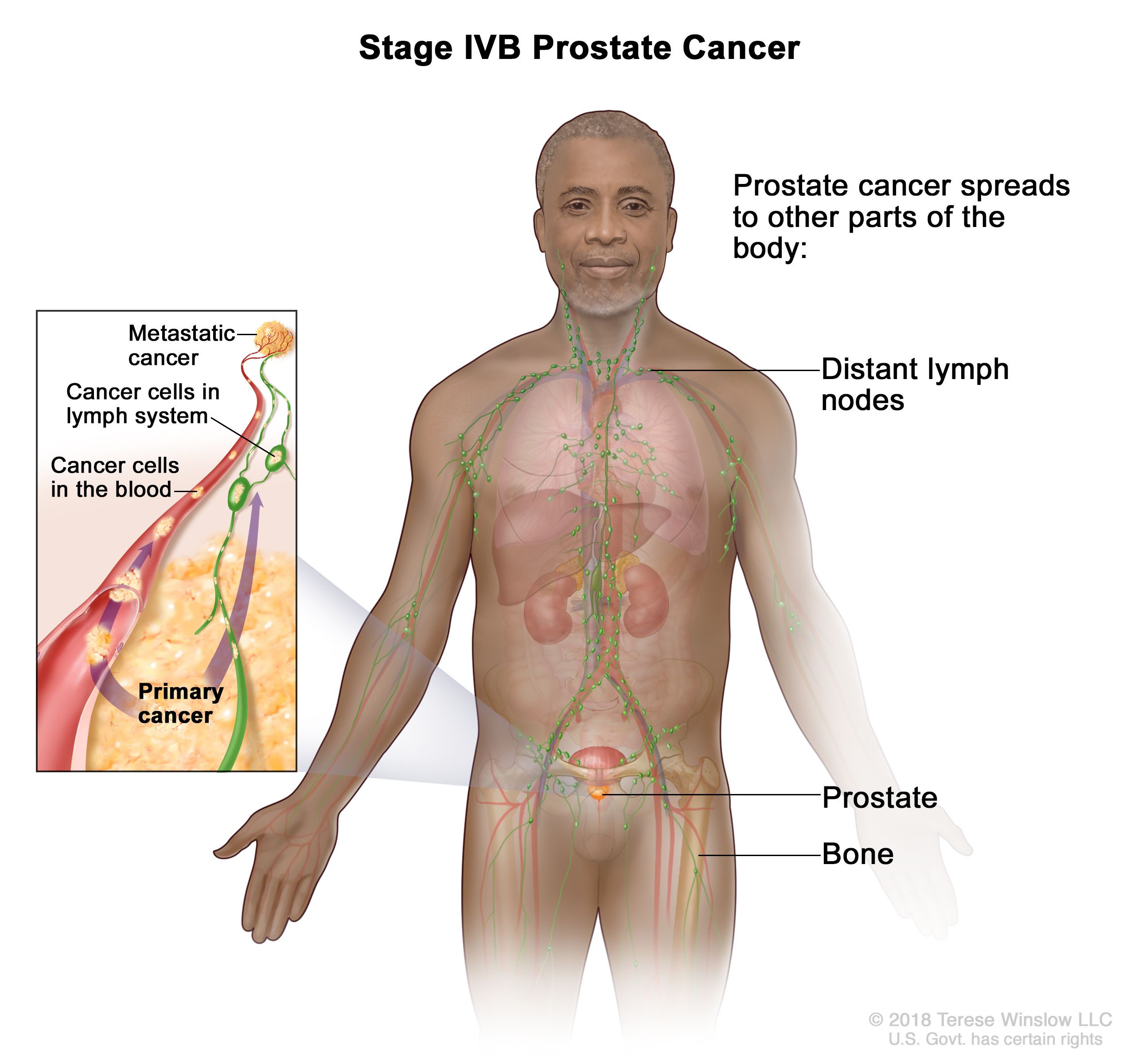 Cancer abdominal lymph nodes