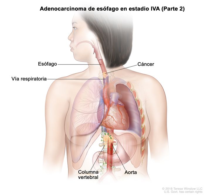 Adenocarcinoma de esófago en estadio IVA (Parte 2). En la imagen se observa cáncer en el esófago, la vía respiratoria, la aorta y la columna vertebral.