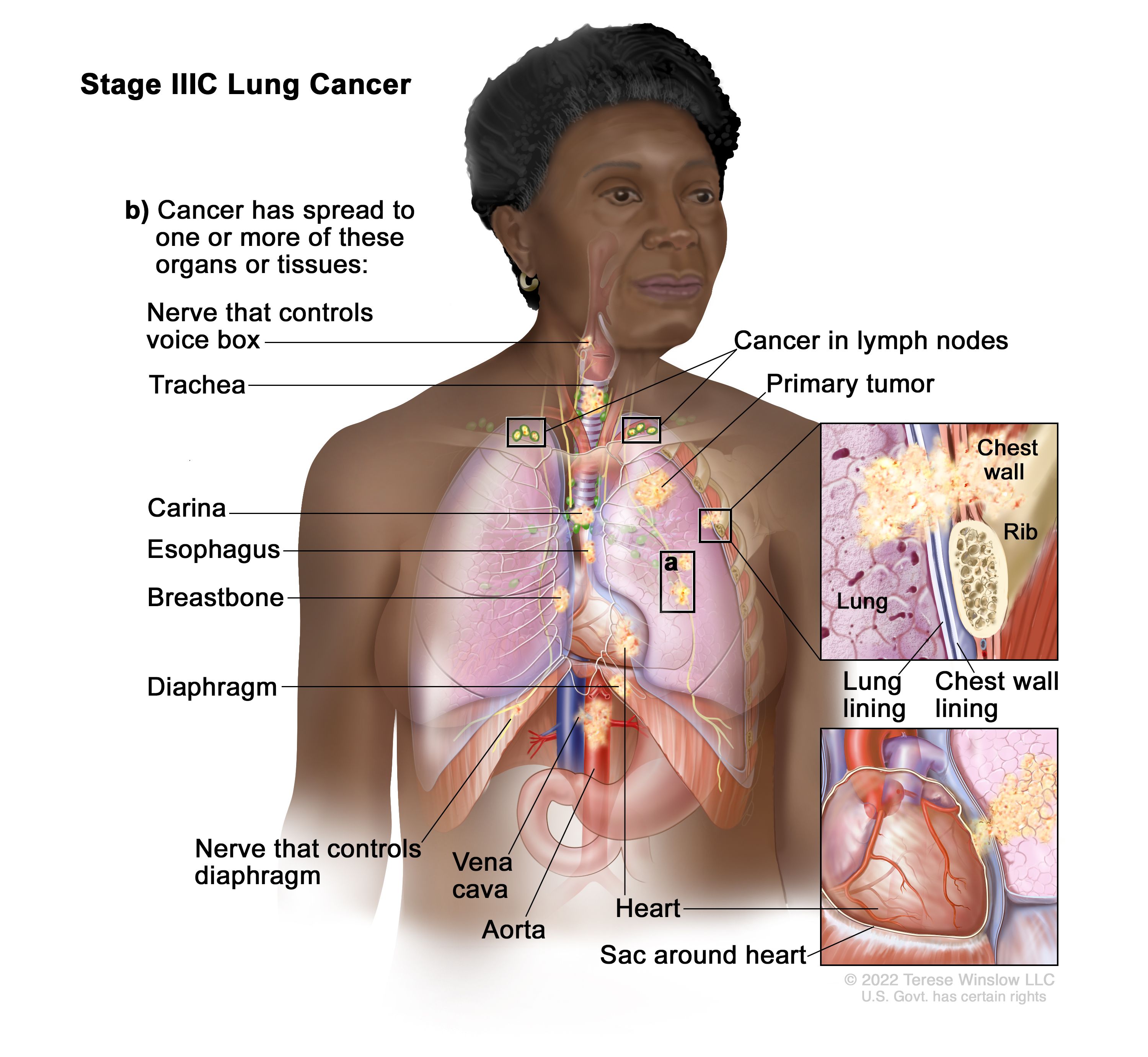 Multiple Metastatic Subcutaneous Nodules Over The Anterior Chest Wall Download Scientific Diagram