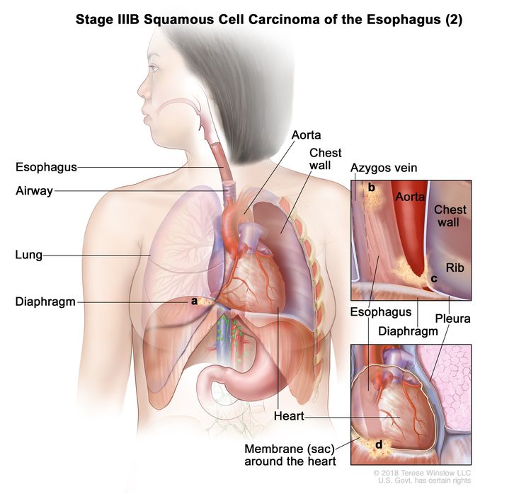 Stage IIIB squamous cell carcinoma of the esophagus (2); drawing shows cancer in the esophagus and in the (a) diaphragm, (b) azygos vein, (c) pleura, and (d) membrane (sac) around the heart. Also shown are the airway, lung, aorta, chest wall, heart, and rib.