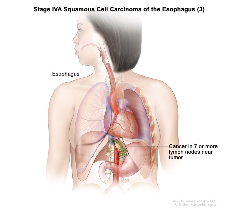 Stage IVA squamous cell carcinoma of the esophagus (3); drawing shows cancer in the esophagus and in 9 lymph nodes near the tumor.