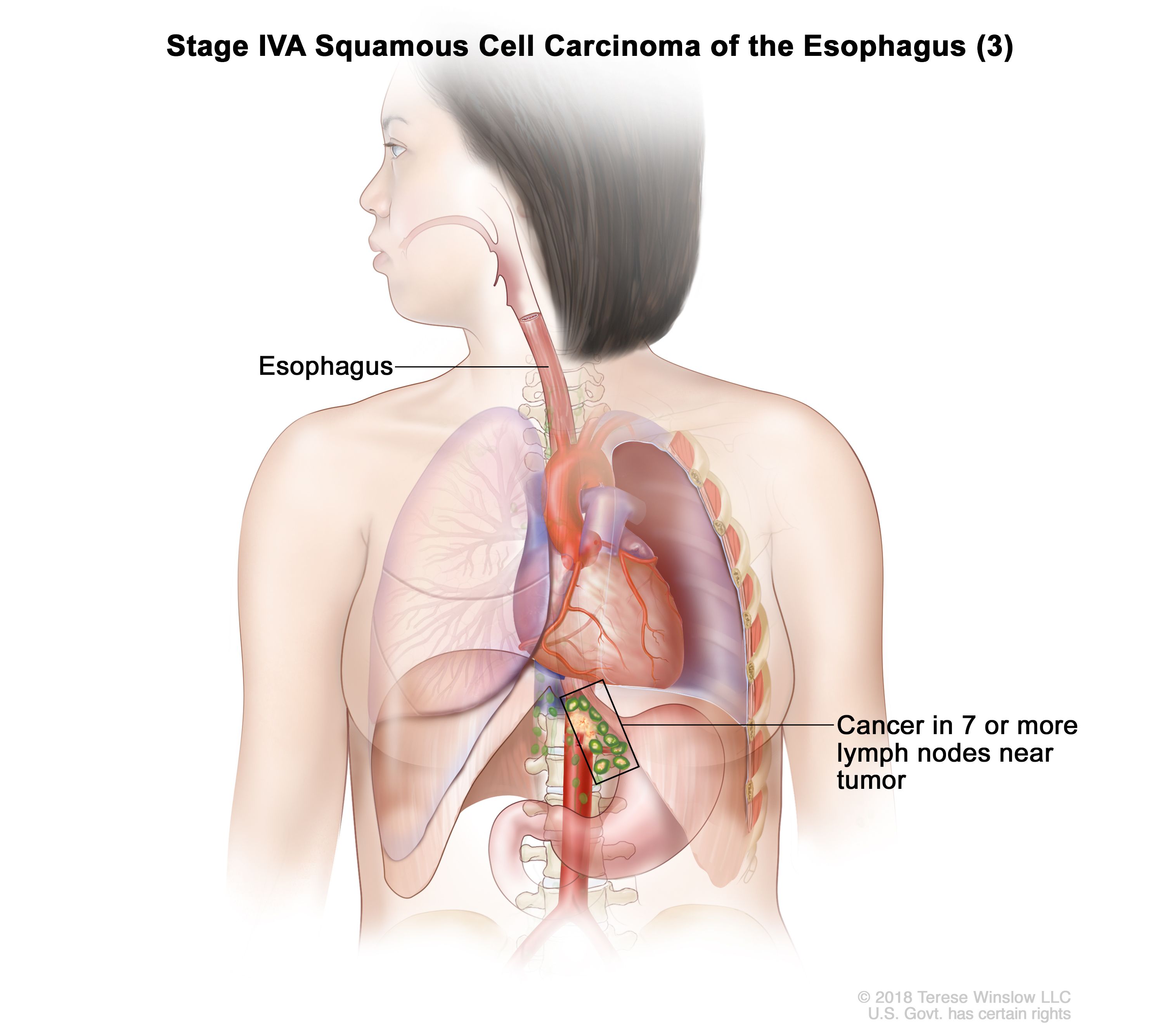 Esophageal Cancer Vanderbilt Ingram Cancer Center