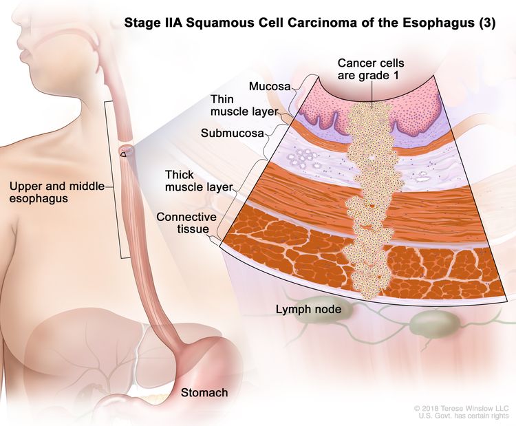 Stage IIA squamous cell carcinoma of the esophagus (3); drawing shows the upper and middle parts of the esophagus and the stomach. An inset shows grade 1 cancer cells in the mucosa layer, thin muscle layer, submucosa layer, thick muscle layer, and connective tissue layer of the upper and middle esophagus wall. The lymph nodes are also shown.