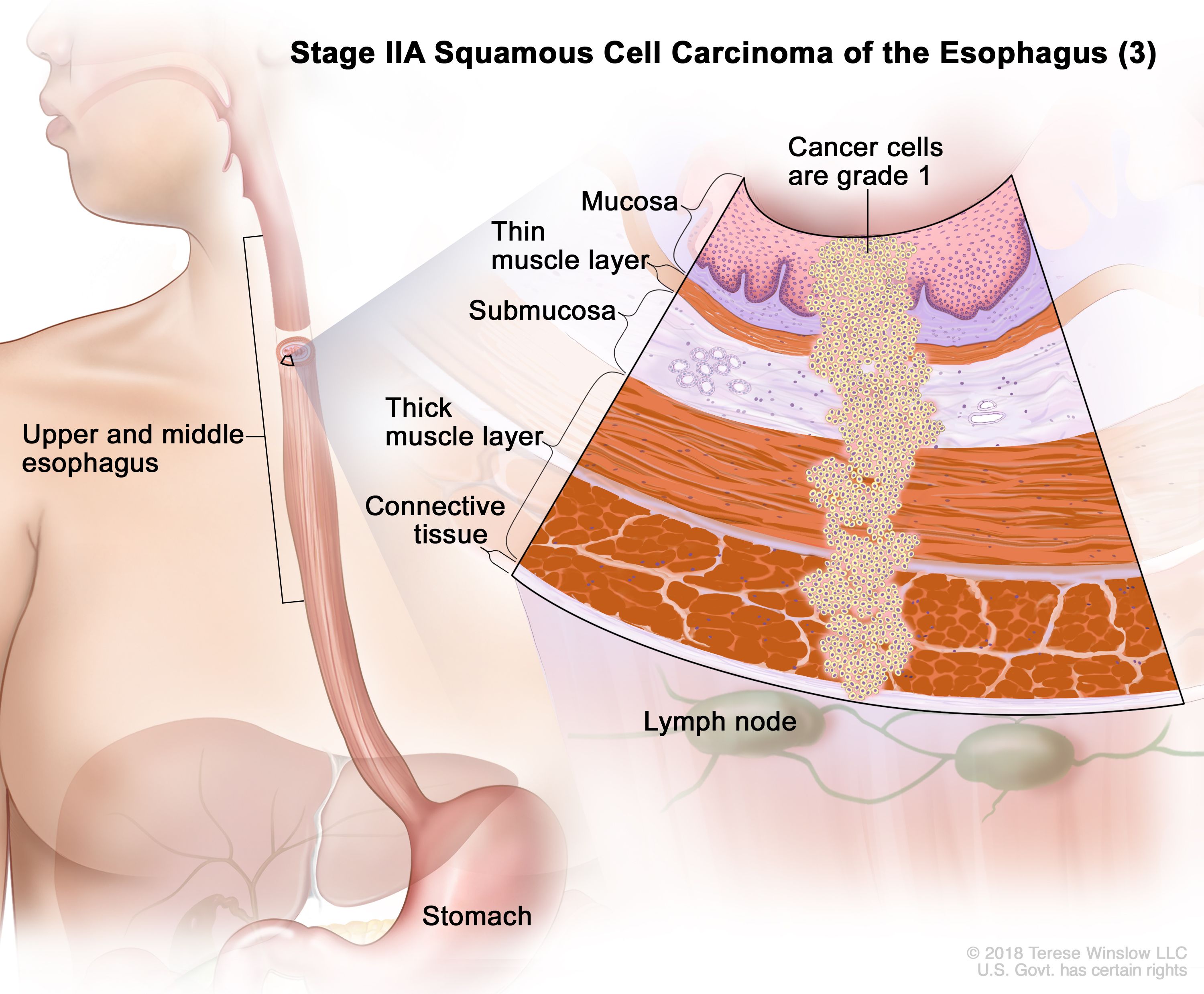 Carcinome épidermoïde de stade IIA de l'œsophage