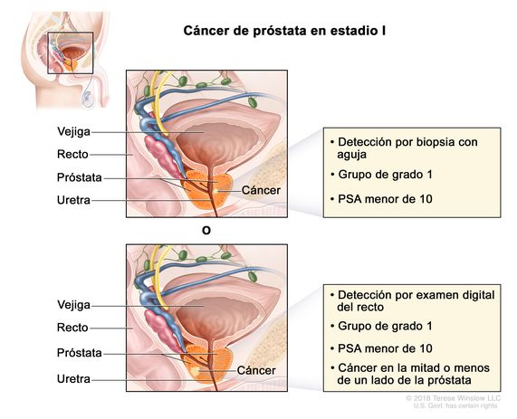 cancer de prostata estadios