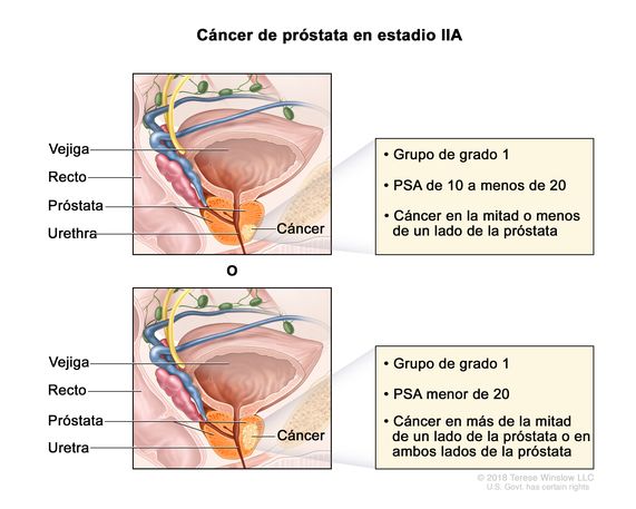 cáncer de próstata grado 4 pronóstico urinare lenta