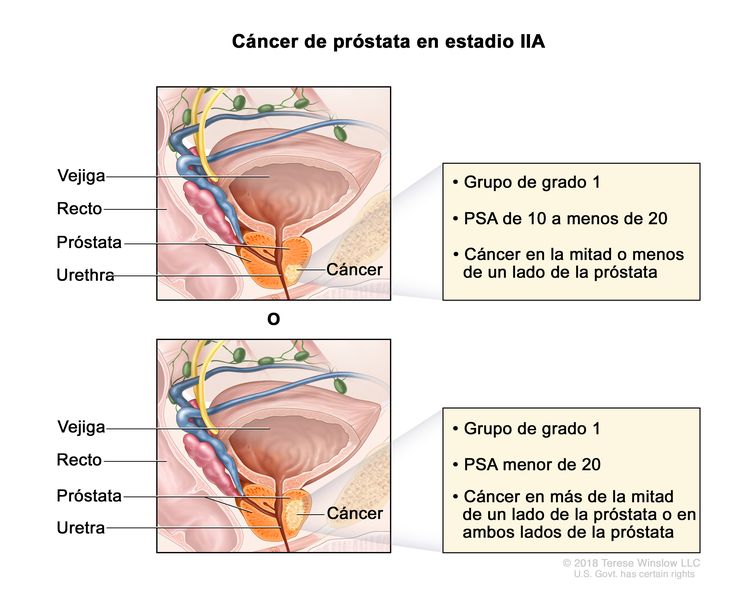 Cáncer de próstata en estadio IIA. Se observa una imagen con dos paneles. En el panel superior, se observa cáncer en la mitad o menos de un lado de la próstata. La concentración del PSA es de 10 a menos de 20 y el grupo de grado es 1. En el panel inferior, se observa cáncer en más de la mitad de un lado de la próstata. La concentración del PSA es menor de 20 y el grupo de grado es 1. En ambos paneles, también se muestran la vejiga, el recto y la uretra.