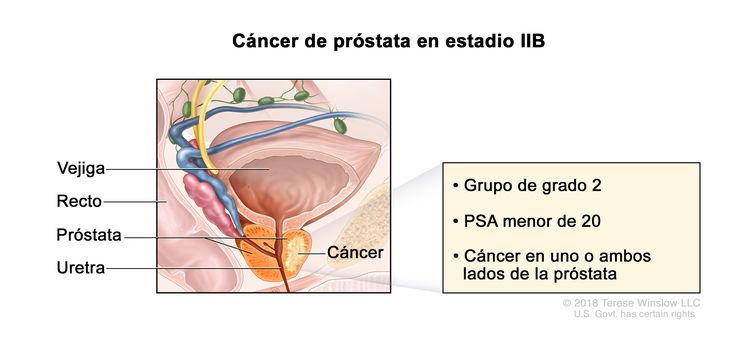 cáncer de próstata sin operación