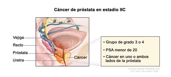 Cáncer de  próstata en estadio IIC. En la imagen se observa cáncer en ambos lados de la próstata. La concentración del PSA es menor de 20 y el grupo de grado es 3 o 4. También se muestran la vejiga, el recto y la uretra.