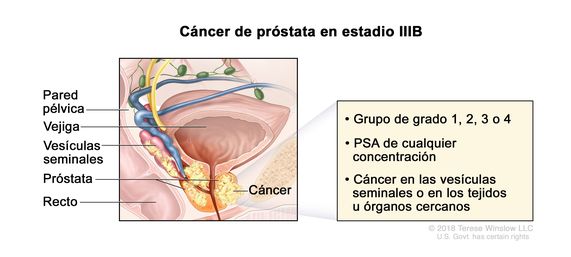 cancer de prostata estadio iv)