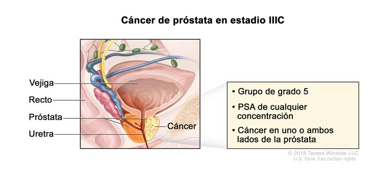 Cáncer de próstata en estadio IIIC. En la imagen se observa cáncer en un lado de la próstata. El PSA es de cualquier concentración y el grupo de grado es 5. También se muestran la vejiga, el recto y la uretra.