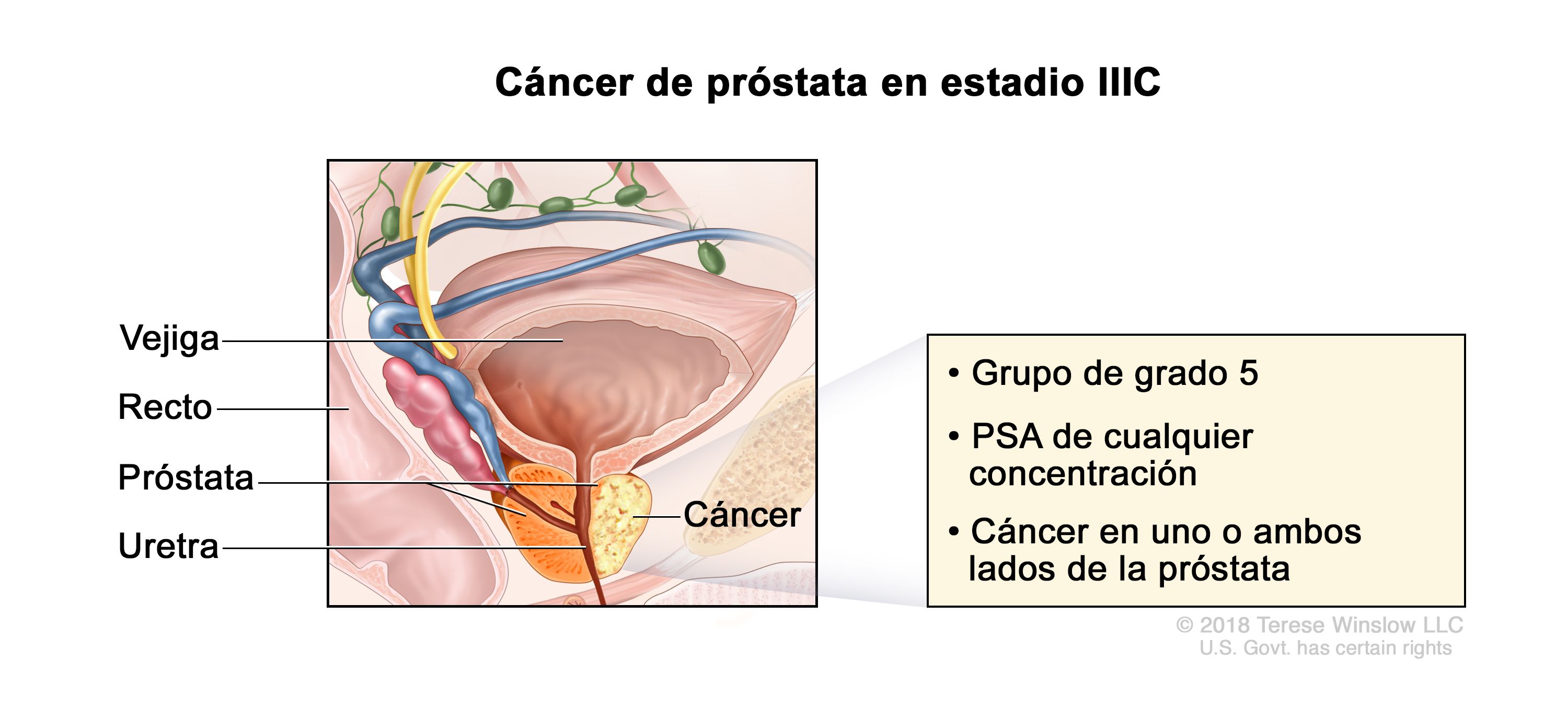 adenoma prostatico psa alto