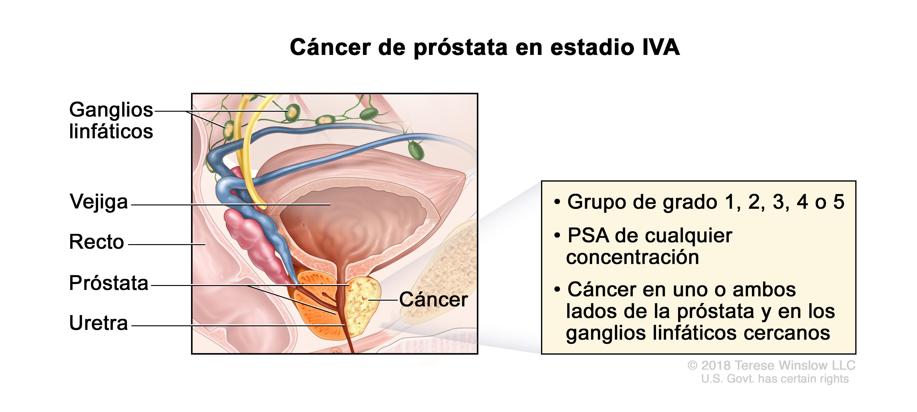 cancer de prostata estadio 2