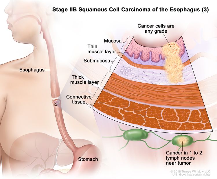 Esophageal Cancer Vanderbilt Ingram Cancer Center