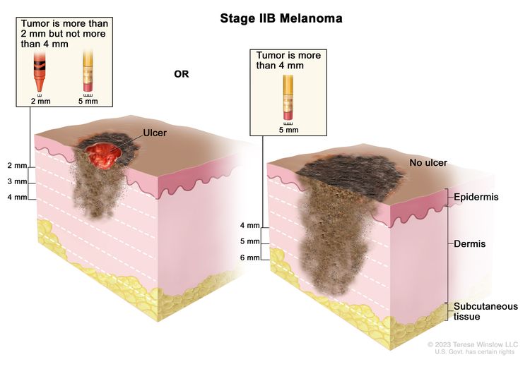 Two-panel drawing of stage IIB melanoma; the panel on the left shows a tumor that is more than 2 but not more than 4 millimeters thick, with ulceration (a break in the skin). There is also an inset that shows 2 millimeters is about the size of a new crayon point and 5 millimeters is about the size of a pencil-top eraser. The panel on the right shows a tumor that is more than 4 millimeters thick, without ulceration. There is also an inset that shows 5 millimeters is about the size of a pencil-top eraser. Also shown are the epidermis (outer layer of the skin), the dermis (inner layer of the skin), and the subcutaneous tissue below the dermis.