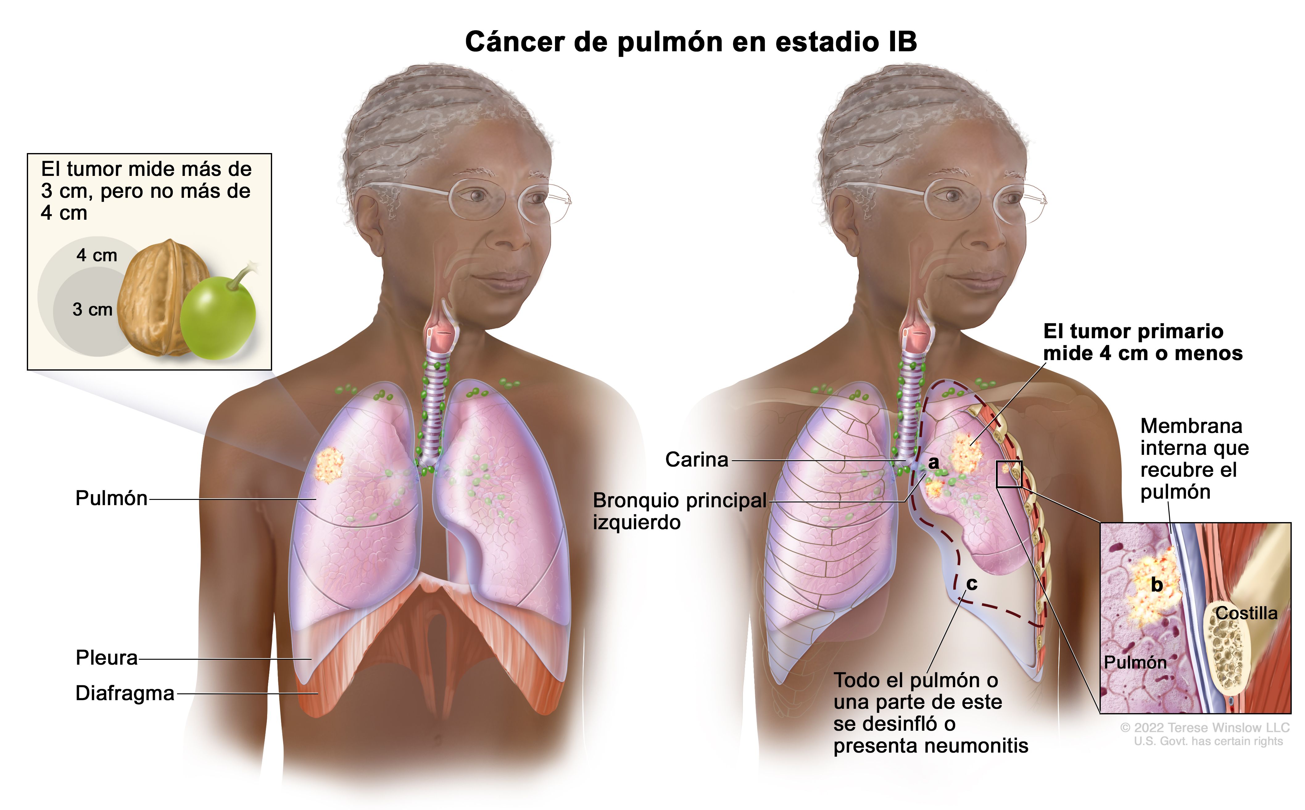 Cancer epitelial de pulmon