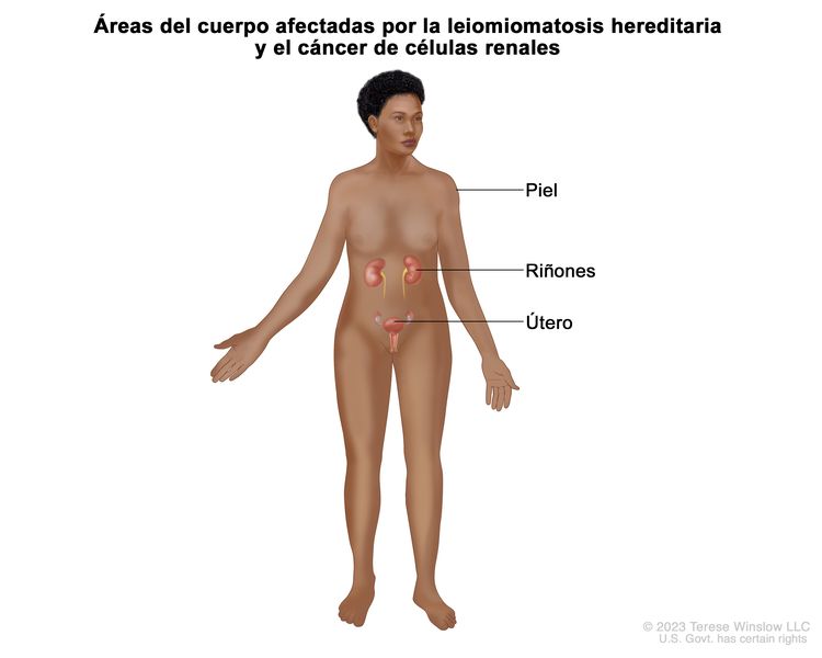 En la imagen se observan las áreas del cuerpo afectadas por la leiomiomatosis hereditaria y el cáncer de células renales, como la piel, los riñones y el útero.