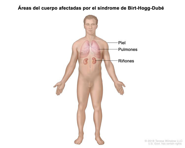 En la imagen se observan las áreas del cuerpo afectadas por el síndrome de Birt-Hogg-Dubé, como la piel, los pulmones y los riñones.